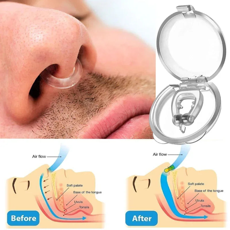 Correcteur anti-ronflement Gadget de prévention du ronflement Dispositif anti-ronflement pour femmes Pince-nez pour l'élimination du ronflement Sommeil nocturne pour hommes