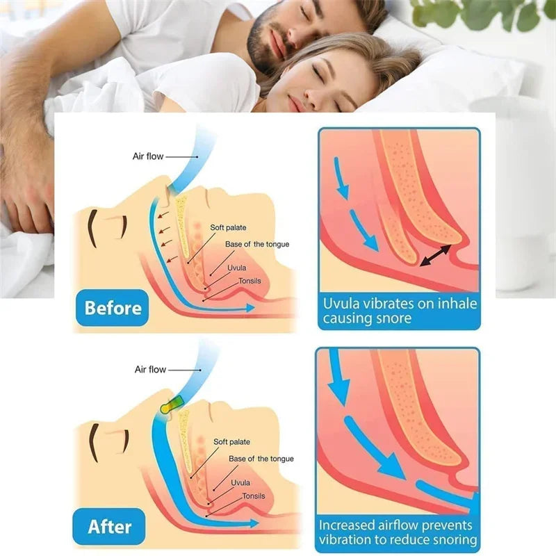 Correcteur anti-ronflement Gadget de prévention du ronflement Dispositif anti-ronflement pour femmes Pince-nez pour l'élimination du ronflement Sommeil nocturne pour hommes